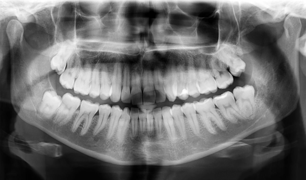 Снимки зубов облучение