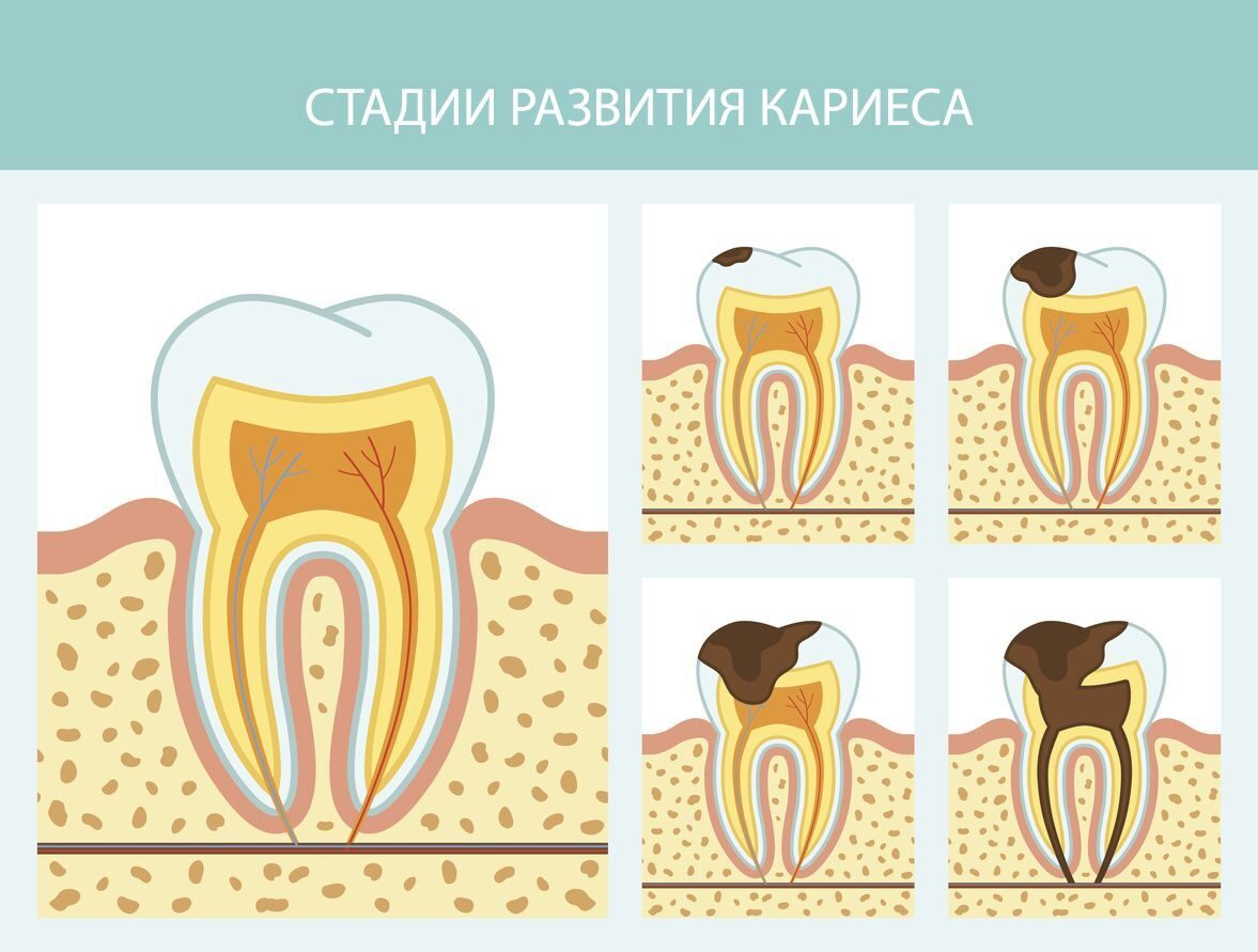 Стадии развития кариеса